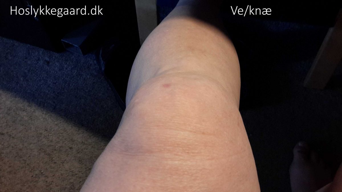 venstre "normal" knæ